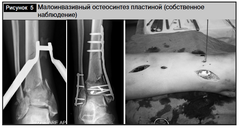 Повреждение мыщелков бедренной кости. Перелом мыщелков бедра